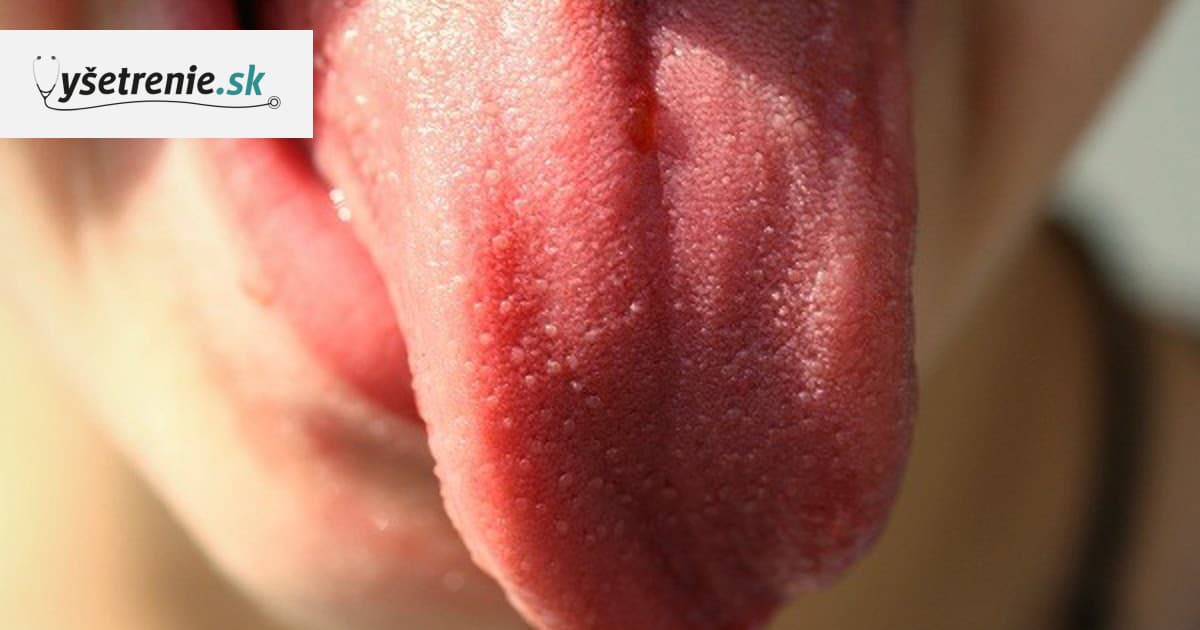 papillomavirus na jazyku